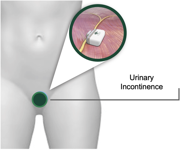 Battery-Powered-Micro-Implant